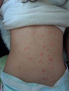 Acne Amoxicillin