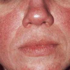 Acne Amoxicillin