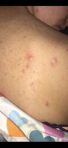 Acne Antibiotics