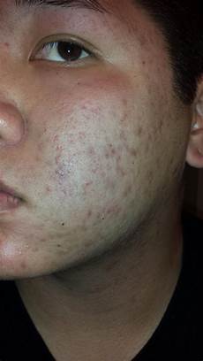 Acne Antibiotics