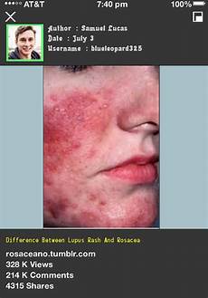 Acne Antibiotics