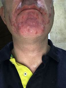 Acne Antibiotics