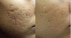 Acne Facial Treatment