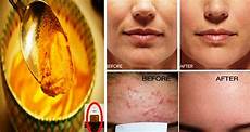 Acne Mask