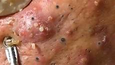 Acne Removing