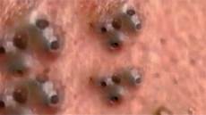 Acne Removing