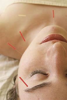 Acne Removing