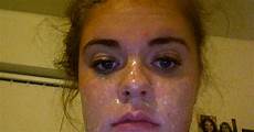 Acne Removing