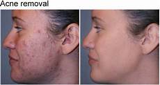 Acne Removing