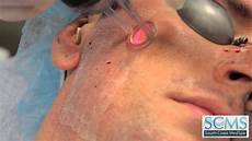 Acne Treatment
