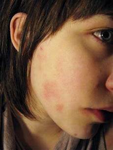 Acne Treatment
