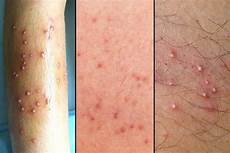 Acne Treatment