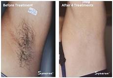 Affordable Laser Hair Removal