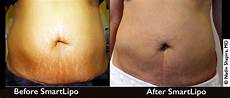 Affordable Laser Hair Removal