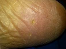 Affordable Laser Hair Removal