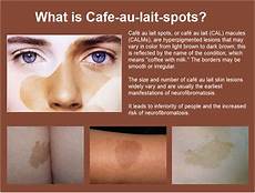 Age Spot Removal Machine