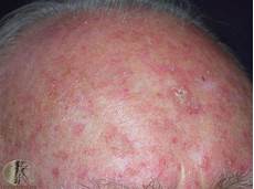 Age Spot Removal Machine