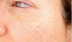 Age Spot Removal