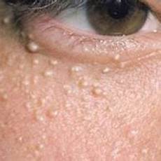 Age Spot Removal
