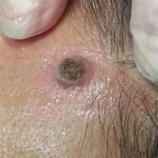 Age Spot Removal