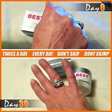 Age Spot Remover