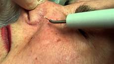 Age Spot Remover