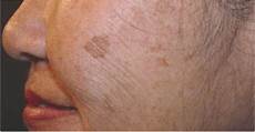 Age Spot Remover