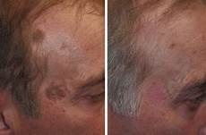 Age Spot Remover