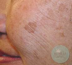 Age Spot