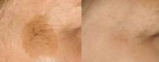 Age Spot