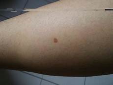 Age Spot