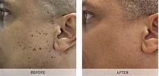Age Spot