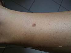Age Spots Removal