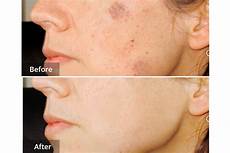 Age Spots Removal