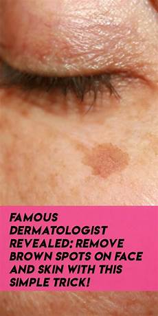 Age Spots Removal