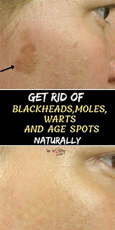 Age Spots Removal
