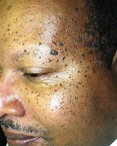 Age Spots Removal