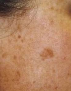 Age Spots Sunspots Au