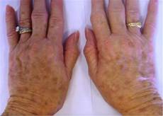 Age Spots Sunspots Au