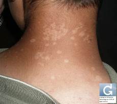 Age Spots Sunspots Au
