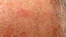 Age Spots Sunspots Au