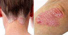 Alternative Remedies Psoriasis