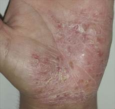 Alternative Remedies Psoriasis