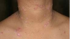 Alternative Remedies Psoriasis