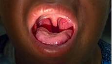 Analgesics