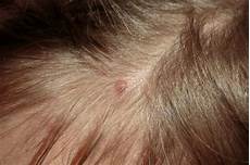 Anti Hair Loss Shampoo