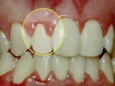 Arabic Gum