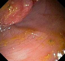 Bone Health