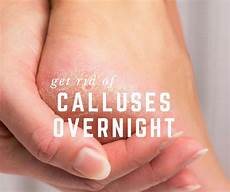 Callus Remover