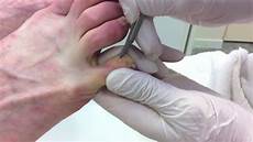 Callus Remover